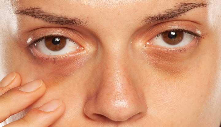 Homeopathic Remedies for Dark Circle Under the Eyes