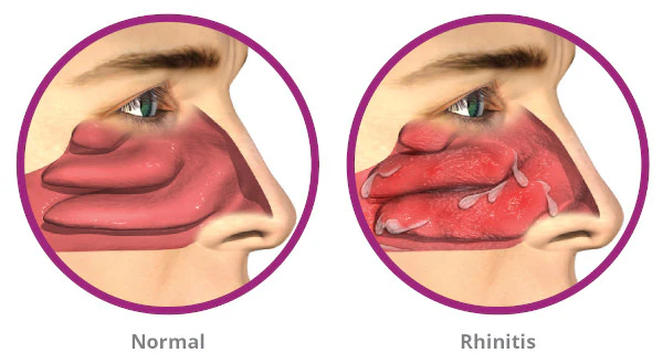 ALLERGIC RHINITIS & HOMEOPATHY TREATMENT