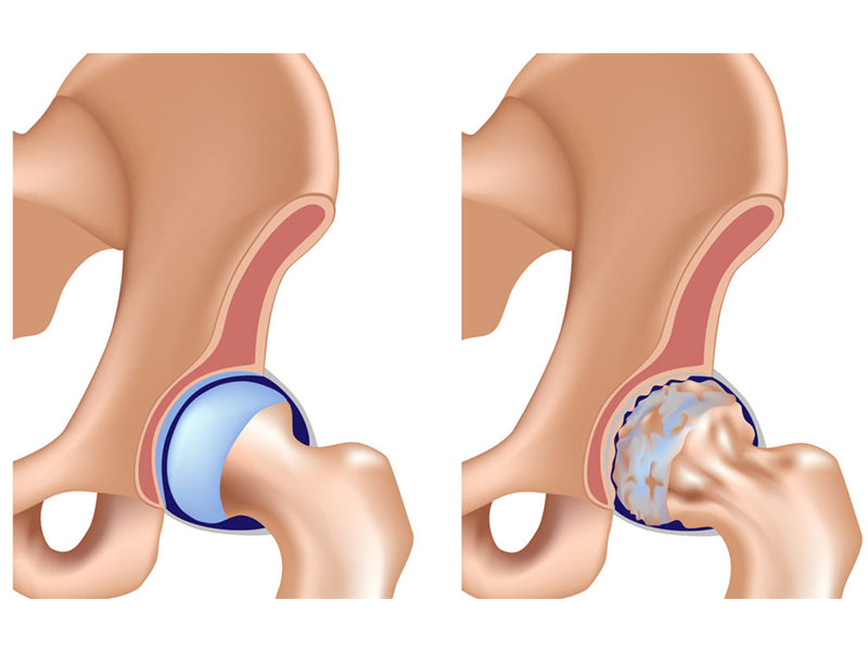 Homeopathic Remedies for AVN – Avascular Necrosis Treatment