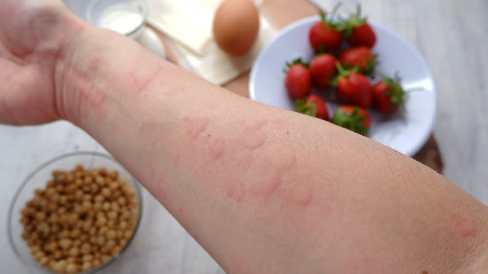 FOOD ALLERGIES AND HOMEOPATHY