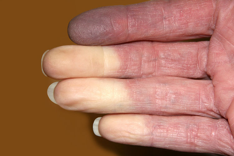 Top Homeopathic Medicines for Raynaud’s Disease