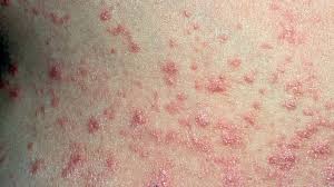 Top Five Homeopathic Medicines for Guttate Psoriasis